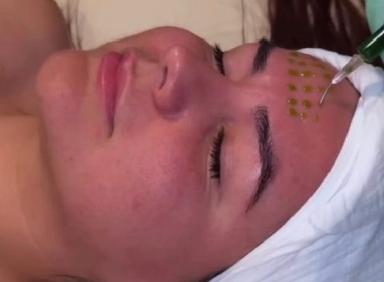 Chemical Peels Treatment in Jacksonville FL